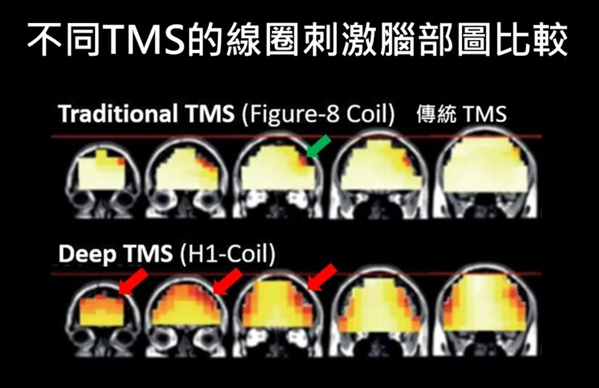 TMS vs dTMS