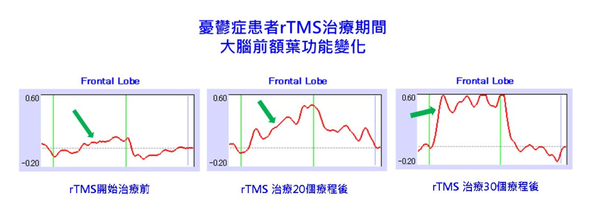 憂鬱症患者rTMS治療期間大腦前額葉功能變化