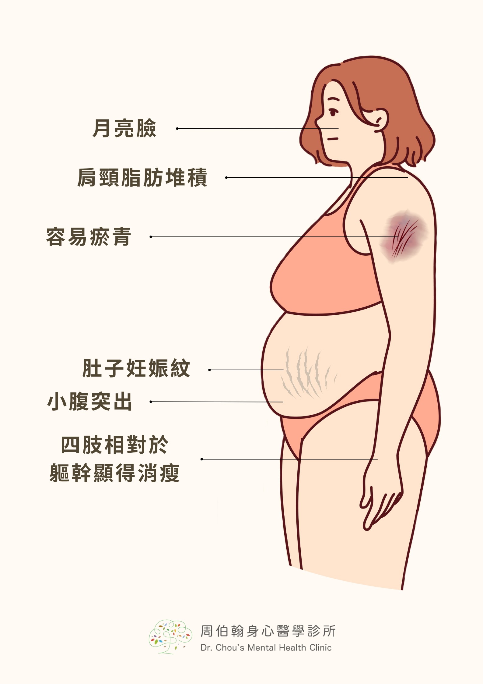 突發憂鬱、失眠與發胖！罕見庫欣氏症候群作怪